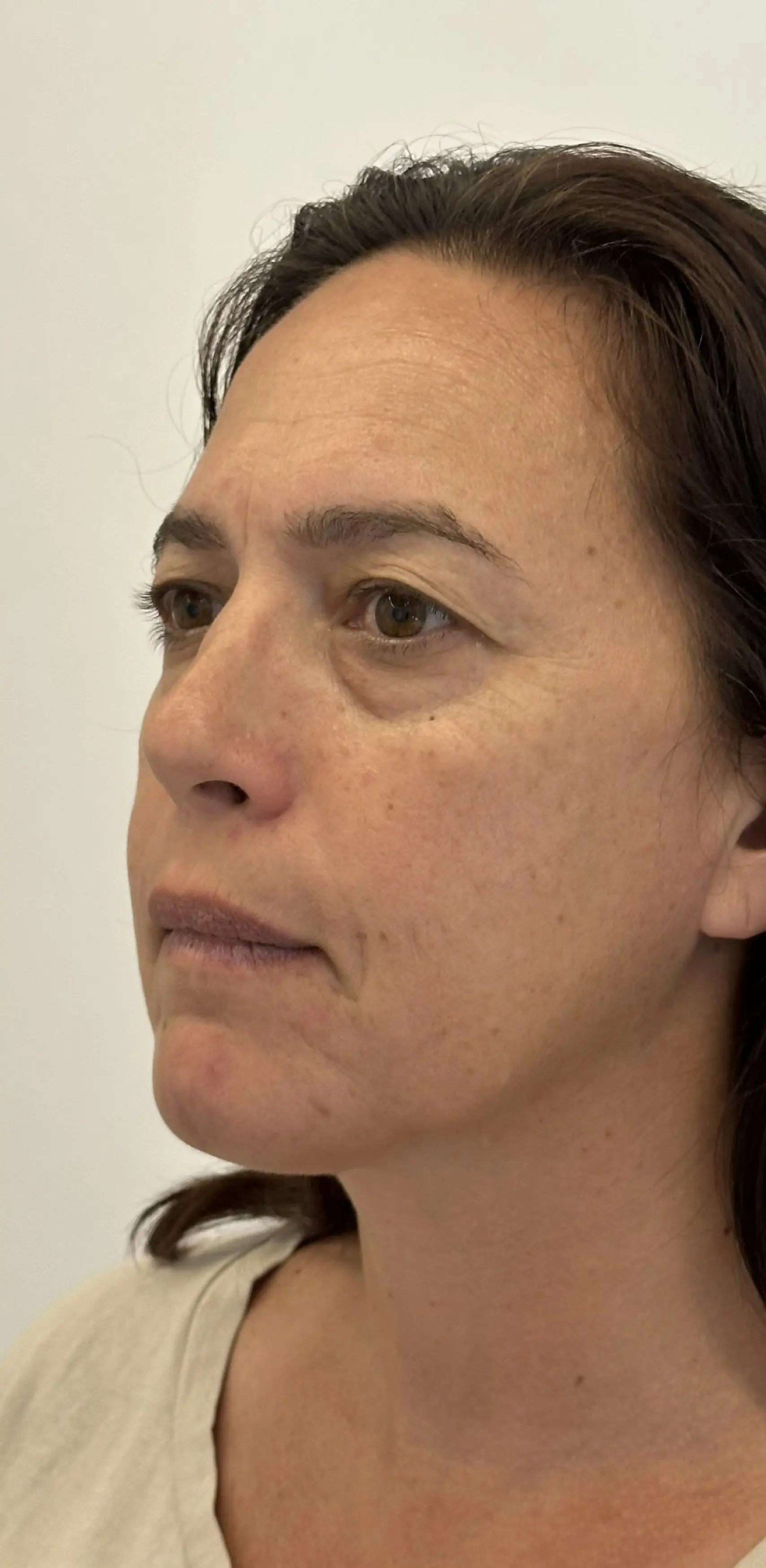 Armonización facial